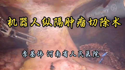 机器人纵隔肿瘤切除术 李基伟教授供稿