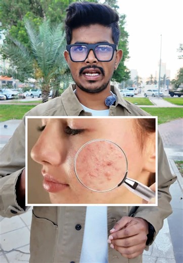 Tamil Malli Face Mask for Pimples