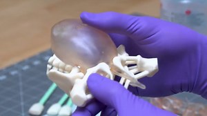 How Engineers are Helping Make a Rare, Complex Surgery Safer