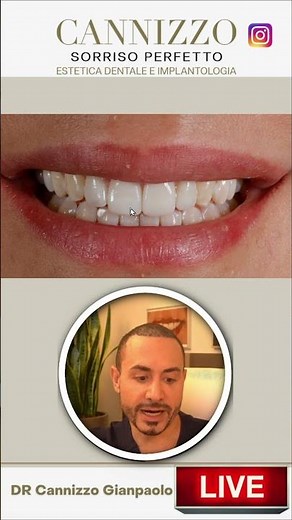 Diastema between the incisors | the solution