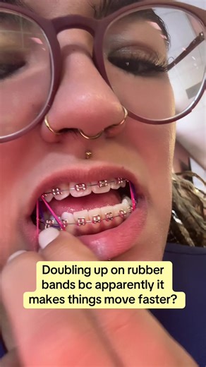 #braces #teeth #straightteeth #orthodontist #dentist | braces