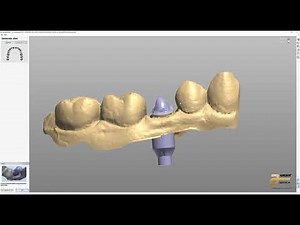 3Shape iTero case through model builder.