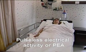 Pulseless electrical activity or PEA