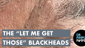 Sandra Lee, MD, FAAD, FAACS on Instagram: "I’ll gladly take these blackheads off your hands! 😈 #LINKINBIO for new blackhead exclusive! #drpimplepopper #blackheads"
