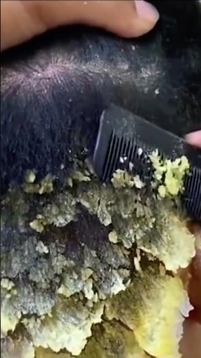 Don't be subjective with dandruff: what is it warning about your health? 🆘
