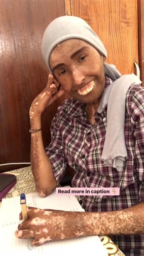 Scleroderma: Understanding the Rare Disease