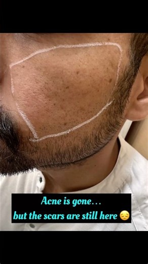 Acne Scars Gone? Fractional CO2 Laser Explained #drashimagoel #parisaskinclinic