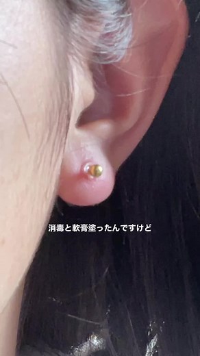 ファーストピアスの腫れとケア方法