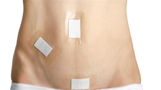 Una recuperación más rápida y menos dolor tras la operación de piedras en la vesícula