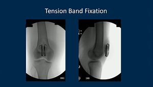 Patella Fracture Update: Should You Tension Band Complex Fractures? What Are New Fixation Methods Are Available?