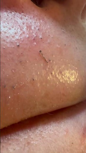 The Satisfaction of Pulling a Single Beard Hair #hairremoval #plucking #tweezers