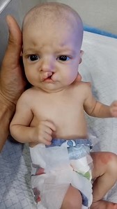 A cleft lip is a birth defect where a gap or split forms in the upper lip because the facial tissues did not join completely during pregnancy #baby #nicucare #NursingSkills #facts #babycare #nicubabynicubaby #babycaretips #viralvideochallenge This can range from a small notch to a more complete split that extends into the nose, and it may occur on one or both sides of the lip. It often requires surgery to repair and can affect feeding, speech, and hearing. Characteristics Appearance: A cleft lip