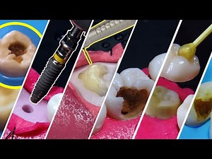 12 BEST dental treatments video compilation in 4K