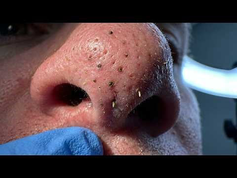 Loan Nguyen Acne Treatment 17ll