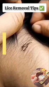 ✅Lice Removal Tips At Home/Best Oil For Lice Removal #shorts #liceremoval #nits #haircaretips #fblifestyle #reelsvideoシ #reelschallenge #fbreelsfypシ゚viralシ #fbreelsvideo #fypreelsシ゚viralシ | Natural Beauty Remedy
