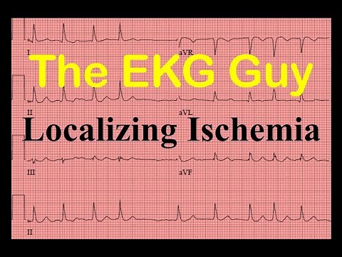 EKG/ECG Localizing Myocardial Ischemia - Question 18.0 | The EKG Guy