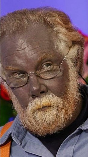 The Blue Man Paul Karason and the Unusual Effects of Colloidal Silver Consumption