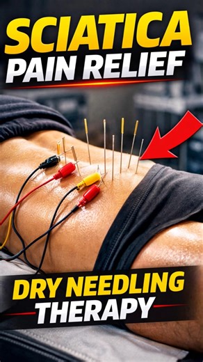 Sciatica PainReliefwith Dry Needling TherapyInstant Leg Pain Relief#backpainrelief #physiotherapist