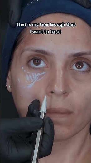 Why We Use 3 Types of Filler When Treating the Under Eye Region 💎 Advice from the GEM© Clinic