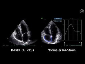 〖Echocardiografie〗Normaler Strain des rechten Atriums - 4-ChV🫀