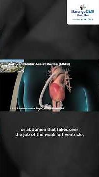 LVAD: A Lifesaving Device for Severe Heart Failure