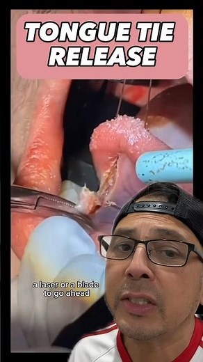 Dentist Explains Tongue Tie Release Treatment | View Mobile Dental #shorts