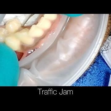 Supernumerary Tooth Causing a Traffic Jam. Step by Step Dental Extraction