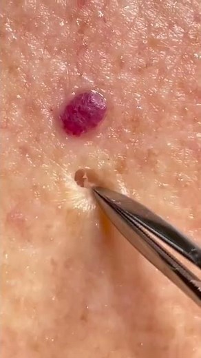 That was quick: Comedone removal on the back