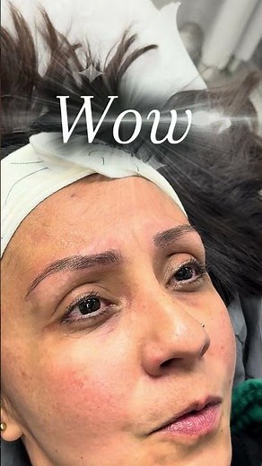 “Microblading Removal Journey (First Session Transformation)”