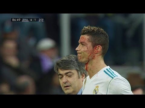 Cristiano Ronaldo INJURY Bleeding Goal - Real Madrid vs Deportivo