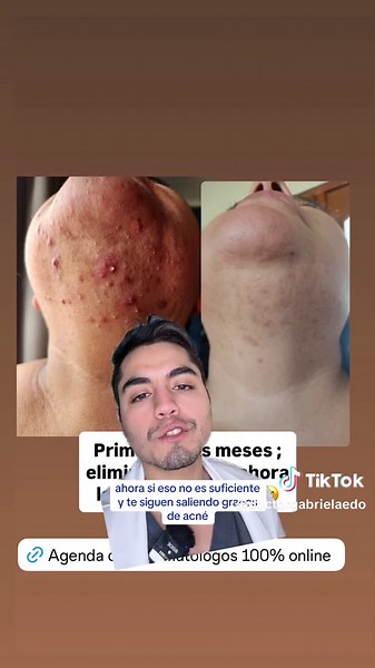 Skincare para el Acné: Consejos y Productos Efectivos