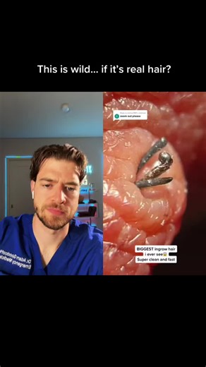 Dr. Adam Goodcoff (@seethemedlife) - Incredible Ingrown Hair Removal by Dermatologist