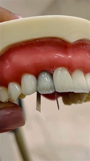 How I Do Veneer Layering on One Tooth | Aesthetic Dentistry ✨🦷 #veneers #brightsmile