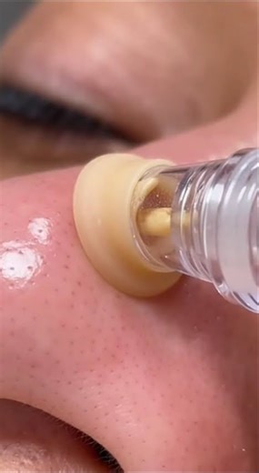 OMG! The Most INSANE Blackhead Extraction You'll Ever See!