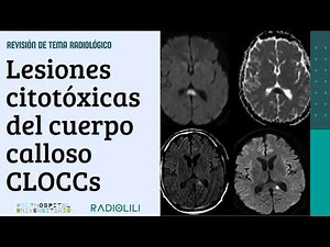 Cytotoxic lesions of the corpus callosum (CLOCCs)