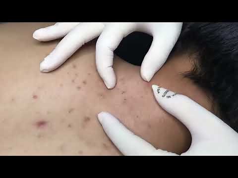 big Blackheads removal on back relaxing With Vu Quynh Mi Spa 2023 #001