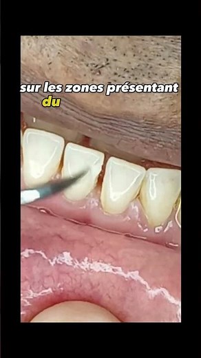 Comment éliminer le tartre dentaire à la maison