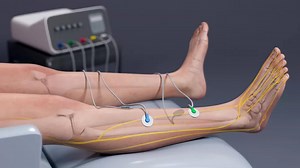 Scrambler Technology Helps Patients with Neuropathic Pain