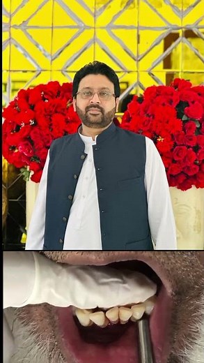 Grade III of Tooth Mobility #loosetooth #tooth #mobility