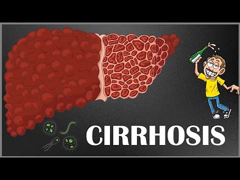 Signs And Symptoms Of Liver Cirrhosis