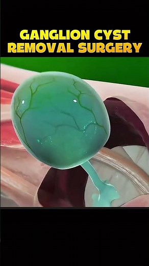 Stunning 3D Visualization of a Cyst Removal /wrist cyst treatment/cyst surgery success