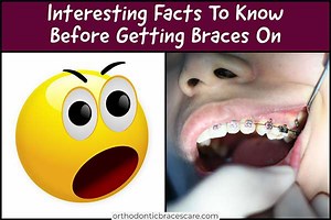 45 Interesting Things To Know Before Getting Braces On - Orthodontic Braces Care