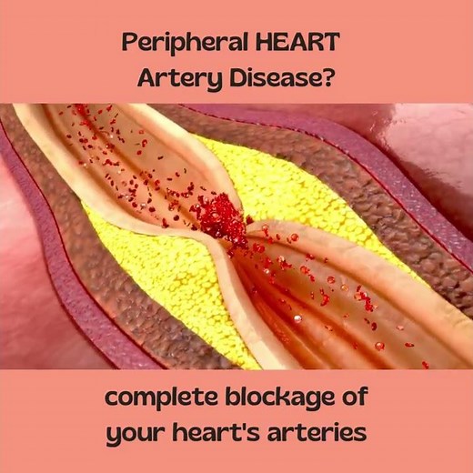 Complete Heart Blockage - Symptoms of Heart Attack