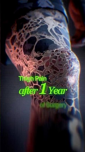 3 Reasons for Thigh Pain One Year After Total Hip Replacement #avn #hipreplacementsurgery