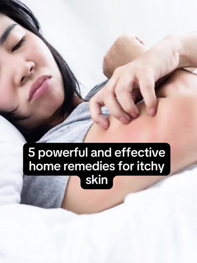 Discover 5 effective home remedies to relieve itchy skin and soothe irritation naturally! #itchyskin #homeremedies #skincare #naturalhealing #shhh #trending #viral #foryou