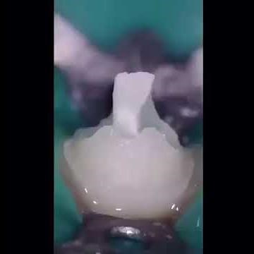 Dental post and core procedure