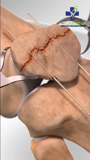 How Patella Fracture is Treated and Its Causes | 3D Video