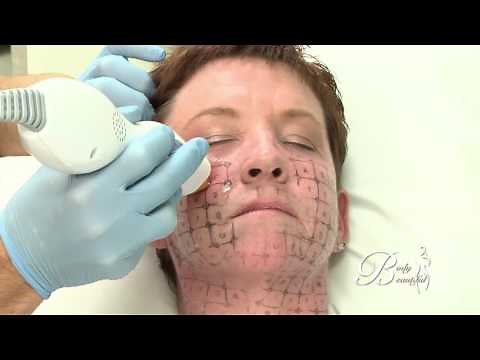 Thermage procedure