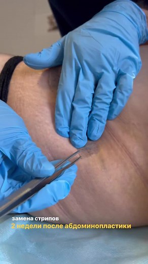 #abdominoplasty #abdominoplastia