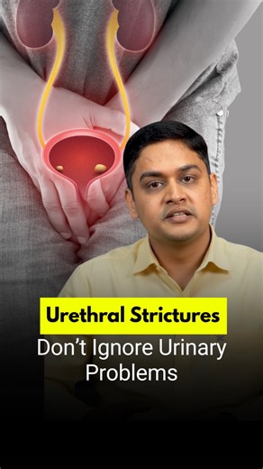 Dr Sandeep Bafna on Instagram: "Urethral strictures are narrowings in the urinary tract caused by infections, trauma, or previous surgeries. They can make urination difficult, increase the risk of infections, and strain the kidneys. Treatment depends on severity and can range from simple dilation to surgical repair. Comment, save, or share to spread awareness about men’s urinary health. Consult a urology specialist at +91 90432 52567 #MensHealth #UrethralStricture #UrologyCare #UrinaryHealth #Ma